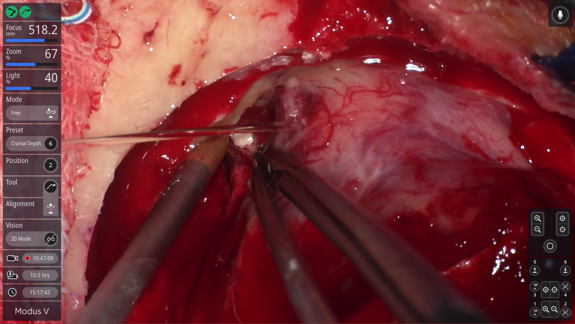 The Modus X live surgical overlay — the surgeon's 4K operative view with controls at the edges