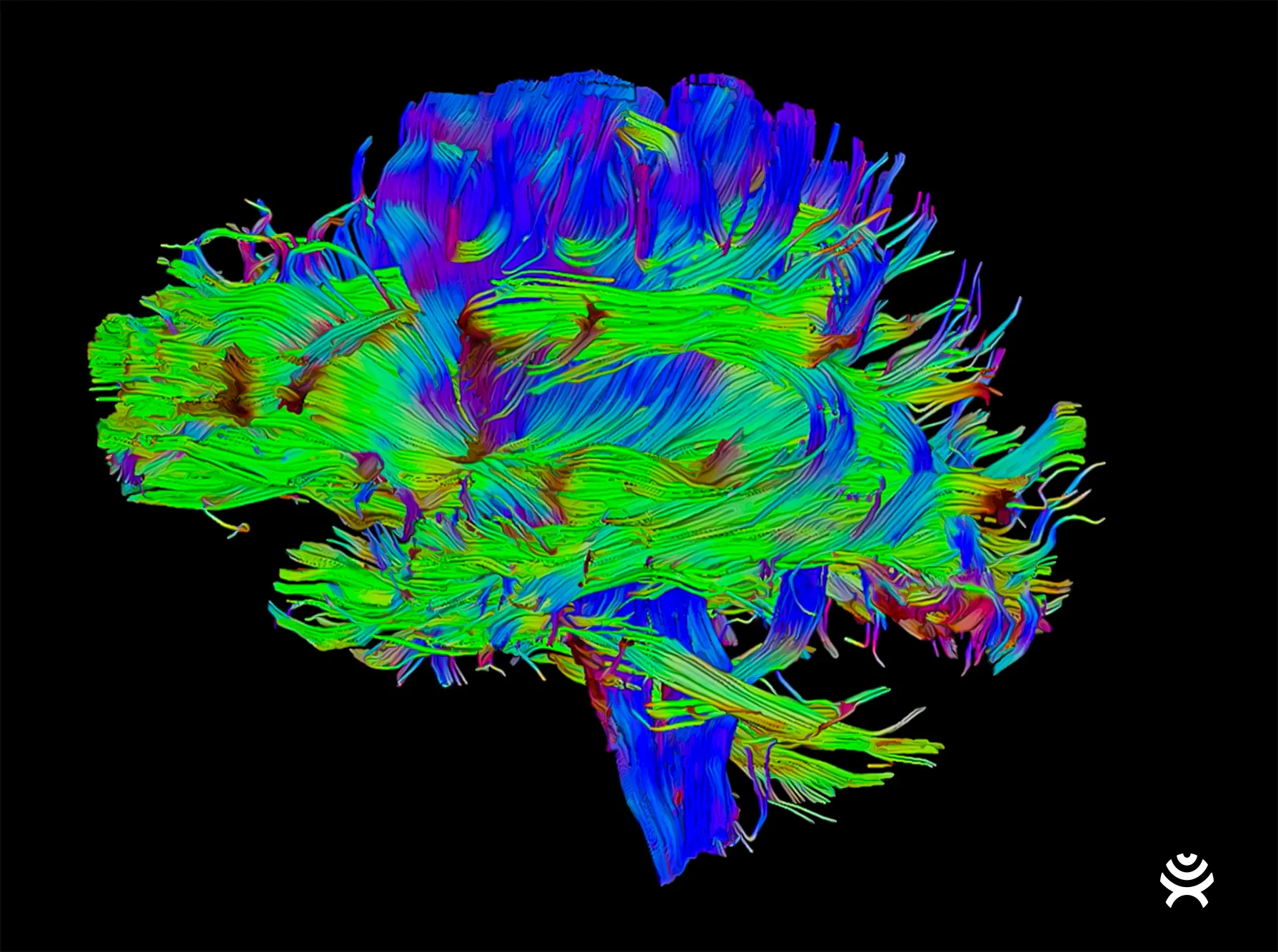 Brain tractography — the neuro-imaging Modus X is built around